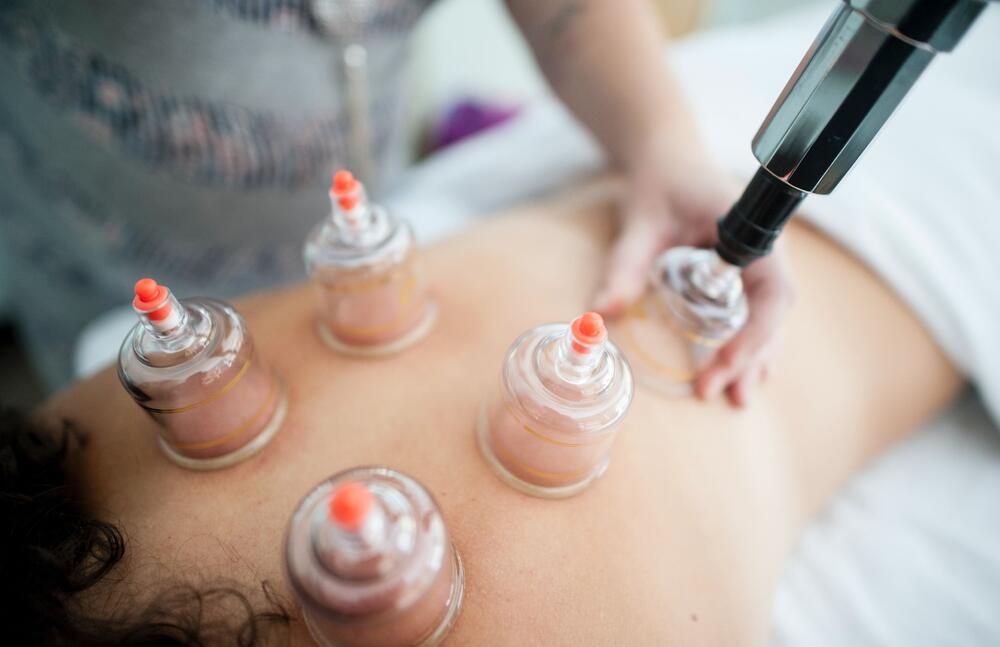 Tout savoir sur la mystérieuse thérapie par ventouses (cupping )